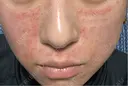 肌育注射（ジュベルックなど） / ピコレーザートーニング（美白・肝斑） / ピコフラクショナルレーザー（毛穴・ニキビ跡） 東京シルククリニック 東京神田院 DAY 1 サムネイル用