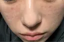 肌育注射（ジュベルックなど） / ピコレーザートーニング（美白・肝斑） / ピコフラクショナルレーザー（毛穴・ニキビ跡） 東京シルククリニック 東京神田院 DAY 4 サムネイル用
