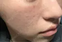 肌育注射（ジュベルックなど） / ピコレーザートーニング（美白・肝斑） / ピコフラクショナルレーザー（毛穴・ニキビ跡） 東京シルククリニック 東京神田院 DAY 4 サムネイル用