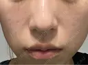 肌育注射（ジュベルックなど） / ピコレーザートーニング（美白・肝斑） / ピコフラクショナルレーザー（毛穴・ニキビ跡） 東京シルククリニック 東京神田院 AFTER サムネイル用