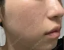 肌育注射（ジュベルックなど） / ピコレーザートーニング（美白・肝斑） / ピコフラクショナルレーザー（毛穴・ニキビ跡） 東京シルククリニック 東京神田院 DAY 7 サムネイル用