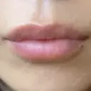 ヒアルロン酸注入（唇） アネシス美容クリニック DAY 3 サムネイル用