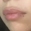 ヒアルロン酸注入（唇） アネシス美容クリニック DAY 4 サムネイル用