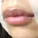 ヒアルロン酸注入（唇） アネシス美容クリニック DAY 5 サムネイル用