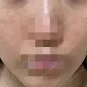 ポテンツァ ルラ美容クリニック 岡山院 DAY 2 サムネイル用