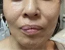 ショッピングリフト Natural Skin Clinic 笹塚院 AFTER サムネイル用