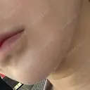 糸リフト / ボトックス（あご） / ヒアルロン酸注入（あご） / RF（高周波）たるみ治療 / ピーリング（ハリ・ツヤ） ルラ美容クリニック 千葉院 / ルラスキンクリニック 千葉院 AFTER サムネイル用