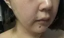 ヒアルロン酸注入（唇） / ヒアルロン酸注入（頬） Wi Clinic （ウィ クリニック）心斎橋院 AFTER サムネイル用