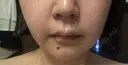 ヒアルロン酸注入（唇） / ヒアルロン酸注入（頬） Wi Clinic （ウィ クリニック）心斎橋院 DAY 3 サムネイル用