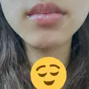 ボトックス（エラ・小顔） TCB東京中央美容外科 天王寺院 AFTER サムネイル用