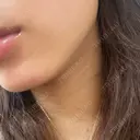 ボトックス（エラ・小顔） TCB東京中央美容外科 天王寺院 DAY 11 サムネイル用