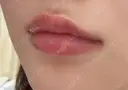 ヒアルロン酸注入（唇） Wing clinic 豊中駅前院 DAY 7 サムネイル用