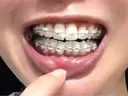 矯正（ワイヤー） X CLINIC 銀座院 DAY 70 サムネイル用