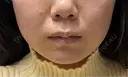 ボトックス（あご） / ボトックス（ガミースマイル） / サーマジェン Wi Clinic （ウィ クリニック）心斎橋院 DAY 0 サムネイル用
