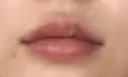 ヒアルロン酸注入（唇） Wing clinic 豊中駅前院 DAY 9 サムネイル用