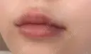 ヒアルロン酸注入（唇） Wing clinic 豊中駅前院 DAY 9 サムネイル用