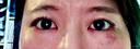ヒアルロン酸注入（涙袋） Leap beauty clinic DAY 0 サムネイル用