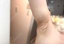 ワキ汗治療（ボトックス） / ワキ汗治療（レーザー） ルラ美容クリニック 渋谷本院 AFTER サムネイル用