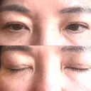 二重埋没 / 目元修正 BELINDA CLINIC（ベリンダクリニック）岡山院 DAY 97 サムネイル用