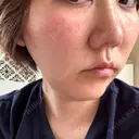 肌育注射（ジュベルックなど） 城本クリニック 岡山院 DAY 1 サムネイル用