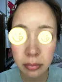 光治療（フォトフェイシャルなど） RAISE CLINIC 【レイズクリニック】 DAY 331 サムネイル用