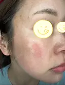 光治療（フォトフェイシャルなど） RAISE CLINIC 【レイズクリニック】 DAY 331 サムネイル用