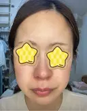 光治療（フォトフェイシャルなど） RAISE CLINIC 【レイズクリニック】 DAY 0 サムネイル用