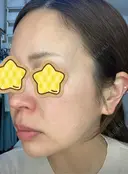 光治療（フォトフェイシャルなど） RAISE CLINIC 【レイズクリニック】 DAY 0 サムネイル用