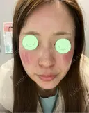 光治療（フォトフェイシャルなど） RAISE CLINIC 【レイズクリニック】 AFTER サムネイル用