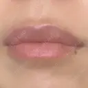 ヒアルロン酸注入（唇） アネシス美容クリニック DAY 7 サムネイル用