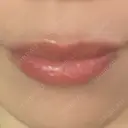 ヒアルロン酸注入（唇） アネシス美容クリニック DAY 8 サムネイル用