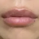 ヒアルロン酸注入（唇） アネシス美容クリニック DAY 9 サムネイル用