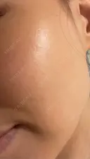 RF（高周波）たるみ治療 渋谷美容外科クリニック 渋谷院 AFTER サムネイル用