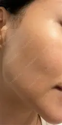 RF（高周波）たるみ治療 渋谷美容外科クリニック 渋谷院 DAY 4 サムネイル用