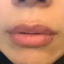 ヒアルロン酸注入（唇） アネシス美容クリニック AFTER サムネイル用