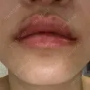 ヒアルロン酸注入（唇） / ボトックス（口角） ルラ美容クリニック 岐阜院 AFTER サムネイル用