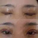 二重切開 / 眼瞼下垂（切開） オーキッド美容クリニック東京御徒町 DAY 4 サムネイル用