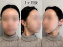 骨切り（あご） / 骨削り（エラ） / 骨削り（頬） セギム美容整形外科 DAY 28 サムネイル用