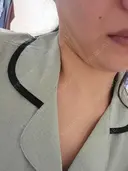 脂肪吸引（顔） アムルーズ美容外科クリニック 横浜院 DAY 36 サムネイル用