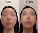 骨切り（あご） / 骨削り（エラ） / 骨削り（頬） セギム美容整形外科 AFTER サムネイル用