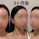 骨切り（あご） / 骨削り（エラ） / 骨削り（頬） セギム美容整形外科 DAY 92 サムネイル用