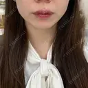ボトックス（エラ・小顔） / ボトックス（肩） フォンタナクリニック天神 AFTER サムネイル用
