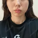 糸リフト Stand by Beauty Clinic AFTER サムネイル用