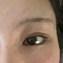 二重埋没 ROOTS Clinic DAY 1 サムネイル用