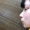 鼻尖形成（切開） / 小鼻縮小（切開） / 軟骨移植 / 眉間プロテーゼ 湘南美容クリニック 熊本院 DAY 10 サムネイル用