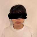 糸リフト / 脂肪吸引（顔） / 脂肪吸引注射（顔） / ヒアルロン酸注入（あご） SEA CLINIC（シークリニック） DAY 63 サムネイル用
