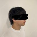 糸リフト / 脂肪吸引（顔） / 脂肪吸引注射（顔） / ヒアルロン酸注入（あご） SEA CLINIC（シークリニック） DAY 63 サムネイル用
