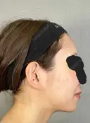 糸リフト / バッカルファット除去 / 脂肪吸引（顔） / ジョールファット除去 / ボトックス（エラ・小顔） アリエル美容クリニック 大宮院 DAY 187 サムネイル用