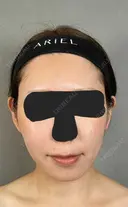 糸リフト / バッカルファット除去 / 脂肪吸引（顔） / ジョールファット除去 / ボトックス（エラ・小顔） アリエル美容クリニック 大宮院 AFTER サムネイル用