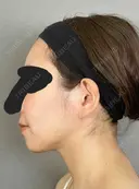 糸リフト / バッカルファット除去 / 脂肪吸引（顔） / ジョールファット除去 / ボトックス（エラ・小顔） アリエル美容クリニック 大宮院 DAY 187 サムネイル用